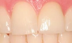 After: front tooth repaired