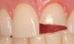 Before: front tooth chipped in half