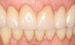 After: white, straight teeth with no gaps