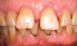 Before: teeth with visible decay and gaps