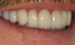 After: bright, white, perfectly straight teeth