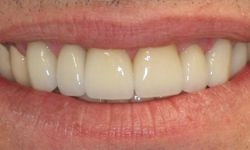 After: straight, white teeth in perfect health