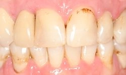 Before: yellowing teeth with visible decay