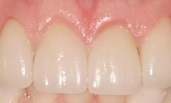 After: straightened teeth with corrected chips