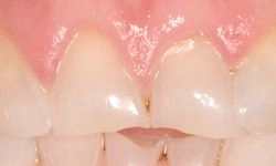 Before: misaligned teeth with chipping