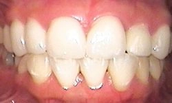 After: front teeth aligned with remainder of smile
