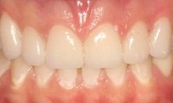 After: perfectly aligned, white teeth