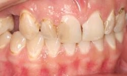 Before: crooked teeth with visible decay