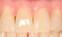 Before: yellowing teeth with gaps