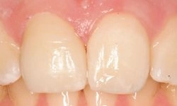 After: fixed front teeth